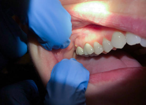 Best Emergency Care for Gum Disease in Winthrop, MN